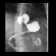 Antireflux plastic, fundoplication, Nissen, slipped above the diaphraghm: RF - Fluoroscopy